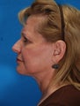 Face and Neck Lift