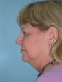 Face and Neck Lift