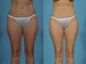 Liposuction