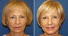 Facelift