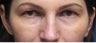 Upper Blepharoplasty 