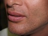Lip augmentation and lift