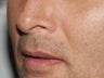Lip augmentation and lift
