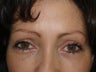 Browlift