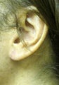 Earlobe Repair