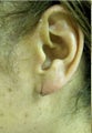 Earlobe Repair
