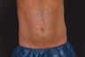 Zeltiq - Coldsculpting on Love Handles