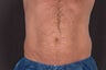 Zeltiq - Coldsculpting on Love Handles