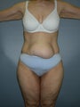 Tummy Tuck
