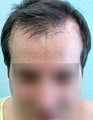FUE – BHT by SFET Using Only Nape, Head and Body Hair