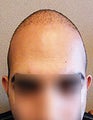 FUE – BHT Using Head, Beard and Body Hair