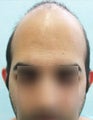 FUE – BHT Using Head, Beard and Body Hair