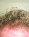 Repair by FUE – SFET Using Head, Nape and Beard Hair to create Hairline
