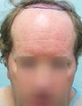 Repair by FUE – SFET Using Head, Nape and Beard Hair to create Hairline