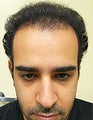 FUE – SFET Using Nape and Head Hair for conservative hairline