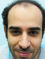 FUE – SFET Using Nape and Head Hair for conservative hairline