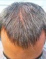 FUE – BHT by SFET Using Only Beard Hair