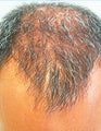 FUE – BHT by SFET Using Only Beard Hair
