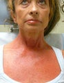 Poikiloderma Treatment with Vbeam
