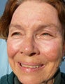 Skin Resurfacing Using Plasma Rejuvenation with Portrait