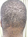 Surgical Treatment of Acne Keloidalis Nuchae