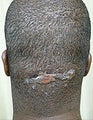 Surgical Treatment of Acne Keloidalis Nuchae