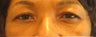 Upper Blepharoplasty 