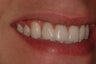 Implant and Cantileeverd Bridge