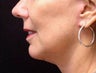 Mini Face-Lift 