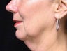 Mini Face-Lift 