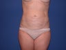 Abdominal liposuction