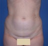 Abdominal liposuction