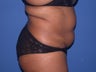 Liposuction on braline, flanks and abdomen