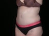 Tummy tuck