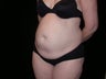 Tummy tuck
