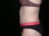 Tummy tuck