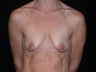 Breast lift