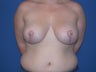 Breast reduction