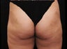 Liposuction