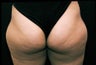 Liposuction