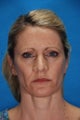 Revision rhinoplasty