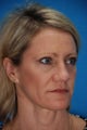 Revision rhinoplasty