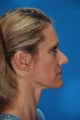 Revision rhinoplasty