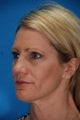 Revision rhinoplasty