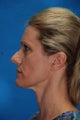Revision rhinoplasty