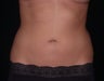 Liposuction