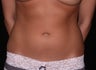 Liposuction
