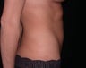 Liposuction