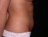 Liposuction
