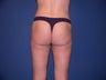 Liposuction